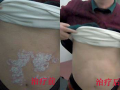 治療好了牛皮癬,我要好好的游個泳 治療好了牛皮癬,我要好好的游個泳