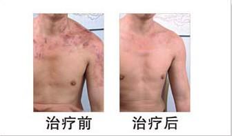 白癜風使我消沉,天津西站醫(yī)院讓我生活信心百倍