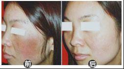 濕疹日夜騷擾,進了天津西站醫院終于擺脫