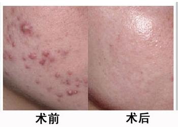 除掉痘痘,還我青春絢麗面容