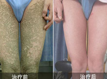 擺脫魚鱗病——學習生活無負擔