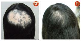 治療脫發(fā)——解決頭等大事 治療脫發(fā)——解決頭等大事