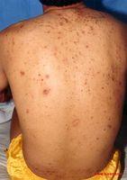 還我青春容顏——痘痘去無憂