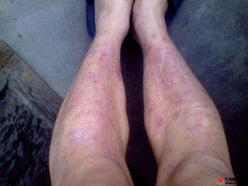 牛皮癬對人體的危害有哪些 牛皮癬對人體的危害有哪些