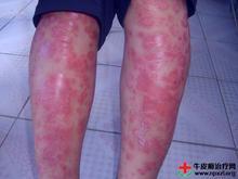 牛皮癬癥狀有哪些特征 牛皮癬癥狀有哪些特征