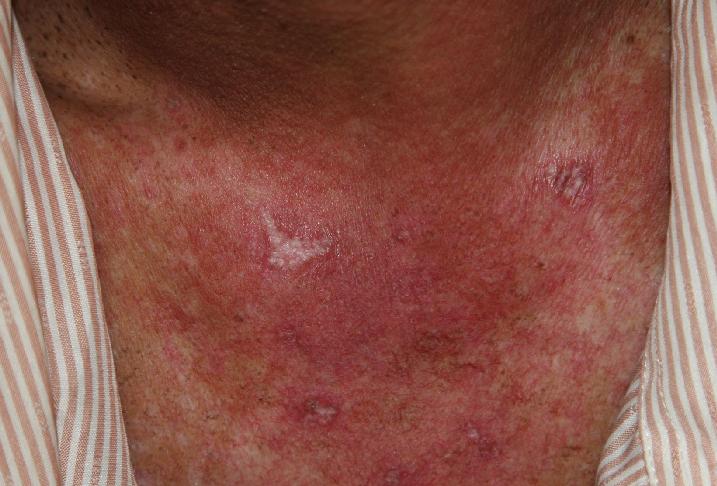 治療神經(jīng)性皮炎需注意的三要素