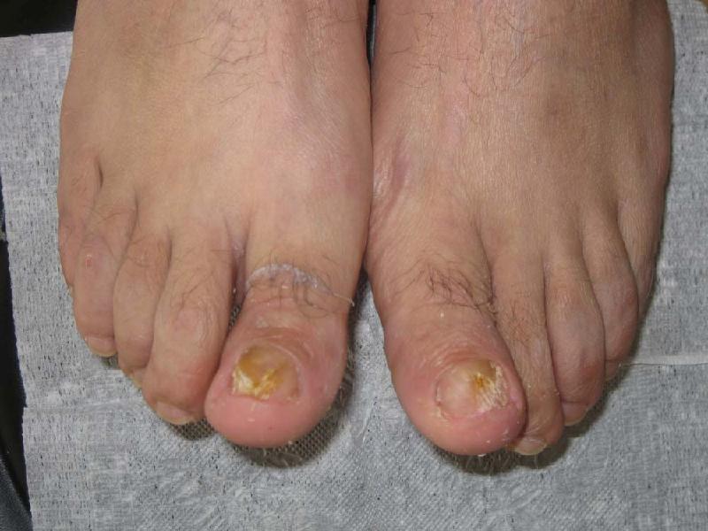 腳上長灰指甲要注意哪些