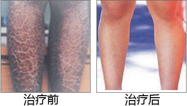 魚鱗治療成功病例