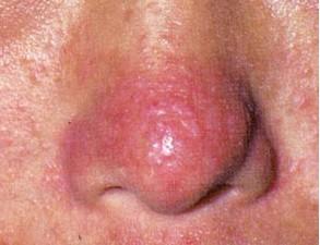 鼻子長痘痘是什么原因