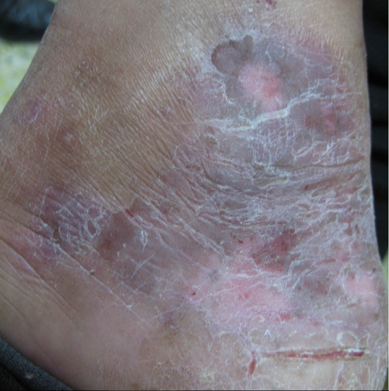 怎樣才能有效防止濕疹的發生