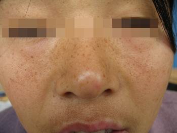 女性黃褐斑是怎么引發的