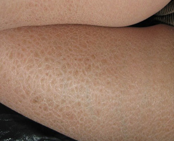 魚鱗病的遺傳特性有哪些?