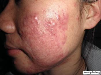 治療痤瘡什么方法效果最好