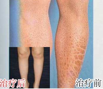 治愈魚鱗病——風采再現