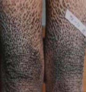 魚鱗病患者要怎樣自我護理