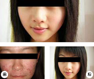 青春痘治療——沒有痘痘就是自信