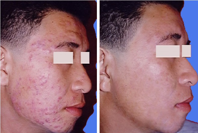 青春痘治愈重拾自信——事業升溫