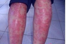 牛皮癬最好的治療方法是什么