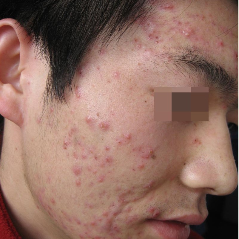 男性青春痘怎么治療