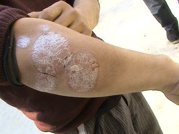 牛皮癬的典型癥狀有哪些