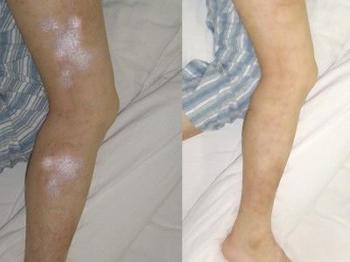 治療魚鱗病最好的醫院是哪家