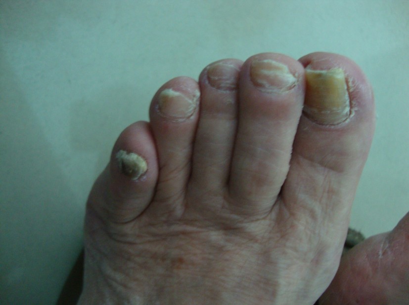 灰指甲是怎么引起的誘因是什么？