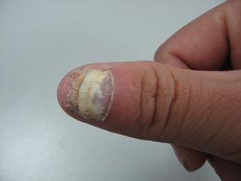 灰指甲的發(fā)展過程有那幾個(gè)步驟