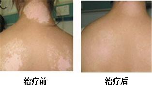 女性白癜風加重的原因是什么