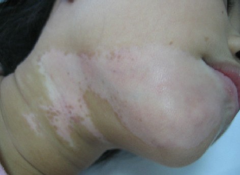 白癜風初期癥狀表現