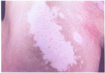 白癜風的早期癥狀怎么發現