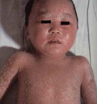 兒童牛皮癬會有哪些癥狀