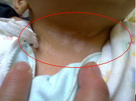 嬰兒白癜風的癥狀