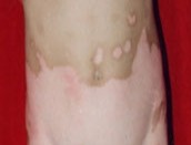 白癜風治療需要多久