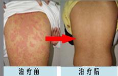 牛皮癬主要發(fā)病的原因是哪些