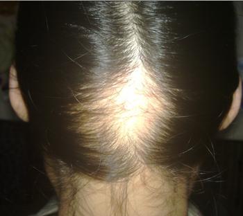 脫發癥狀圖 脫發癥狀圖