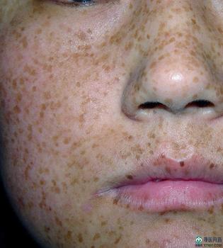 形成黃褐斑的原因是什么