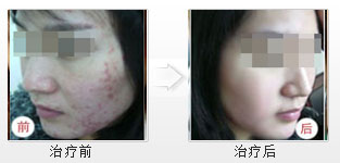 女大學(xué)生治愈青春痘,從此沒煩惱 女大學(xué)生治愈青春痘,從此沒煩惱