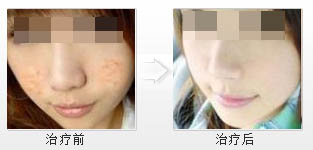 大學生痘痘終于治好了 大學生痘痘終于治好了