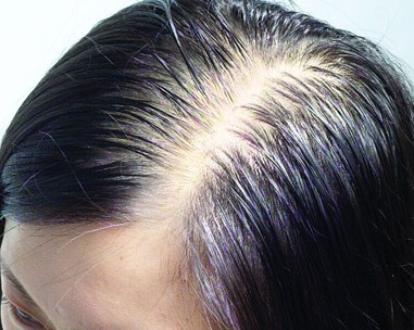 失眠引起脫發的因素有哪些 失眠引起脫發的因素有哪些