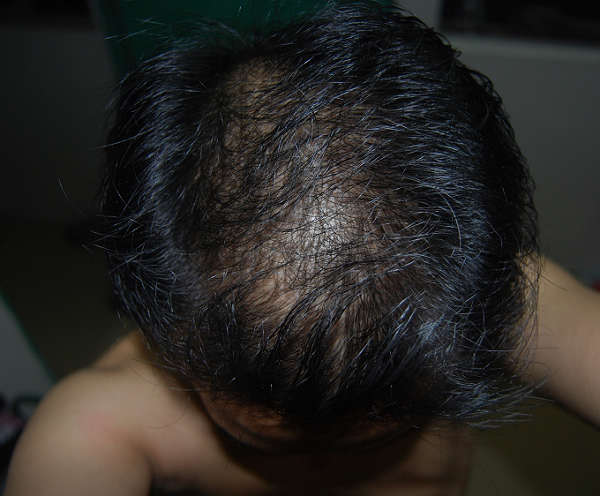 引起脂溢性脫發的原因有哪些 引起脂溢性脫發的原因有哪些