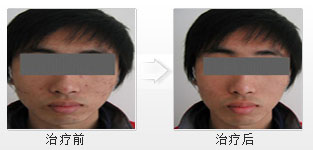 我的青春痘終于治好了 我的青春痘終于治好了
