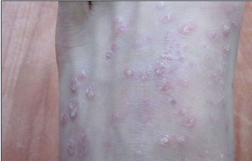 引起牛皮癬的發(fā)病因素有什么 引起牛皮癬的發(fā)病因素有什么