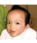 兒童牛皮癬的病因你了解嗎 兒童牛皮癬的病因你了解嗎