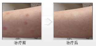 治愈牛皮癬,讓孩子遠離自閉 治愈牛皮癬,讓孩子遠離自閉