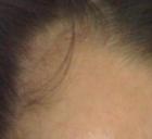 先天性脫發有哪些癥狀 先天性脫發有哪些癥狀