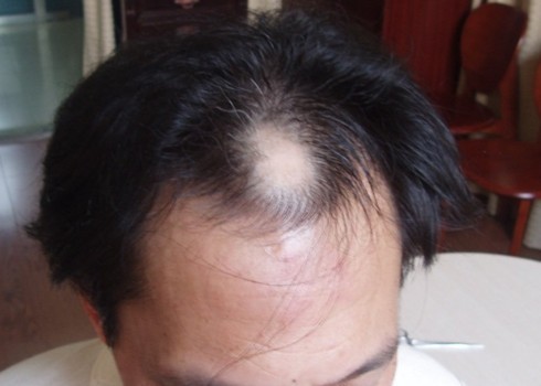 脫發(fā)患者平時(shí)應(yīng)該注意什么 脫發(fā)患者平時(shí)應(yīng)該注意什么