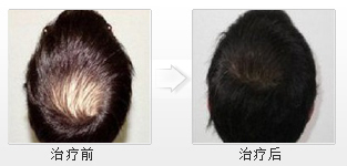 治愈了脫發(fā)，我的工作也有了