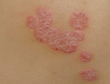 牛皮癬患者在生活中應該注意什么