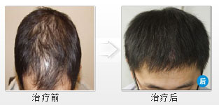 骨干終于治好了精神性脫發(fā) 骨干終于治好了精神性脫發(fā)