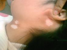 女性患白癜風的原因有哪些 女性患白癜風的原因有哪些